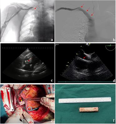 Migration of covered stents in thoracic central vein obstruction procedures in patients with hemodialysis: Case report and literature review